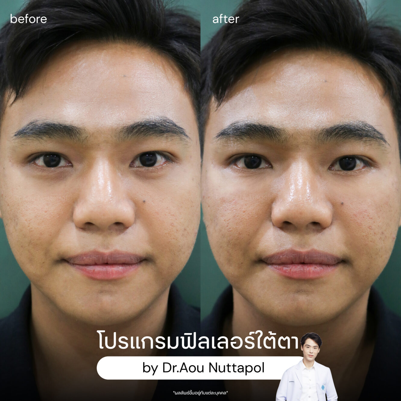 BA filler ใต้ตา 04