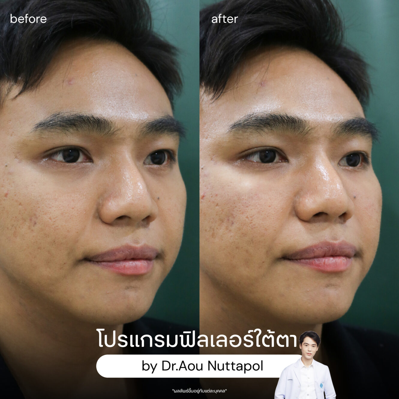 BA filler ใต้ตา 05