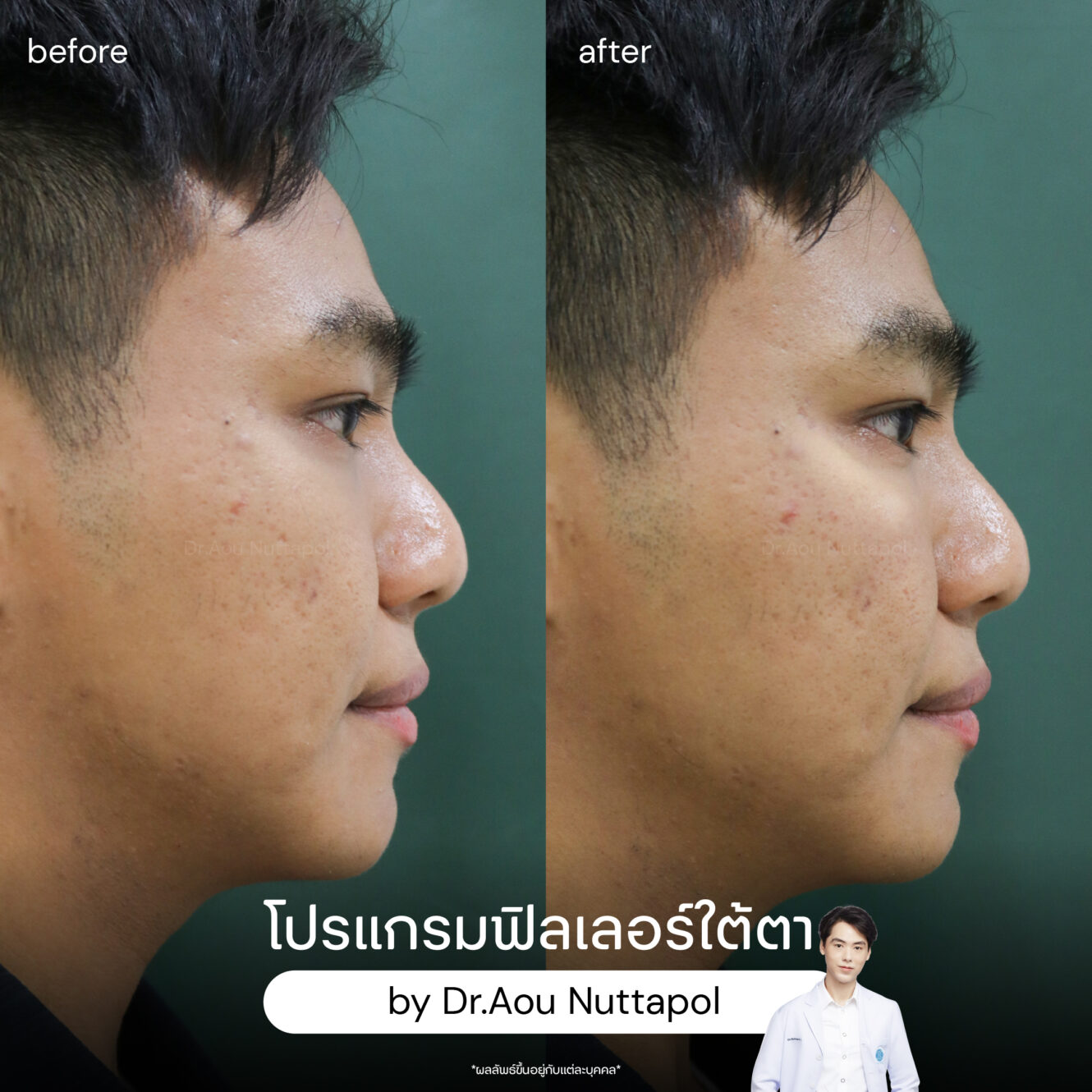 BA filler ใต้ตา 06