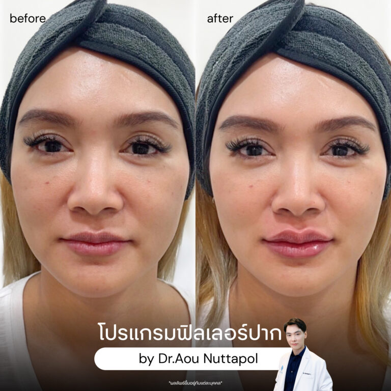 lip-filler-review