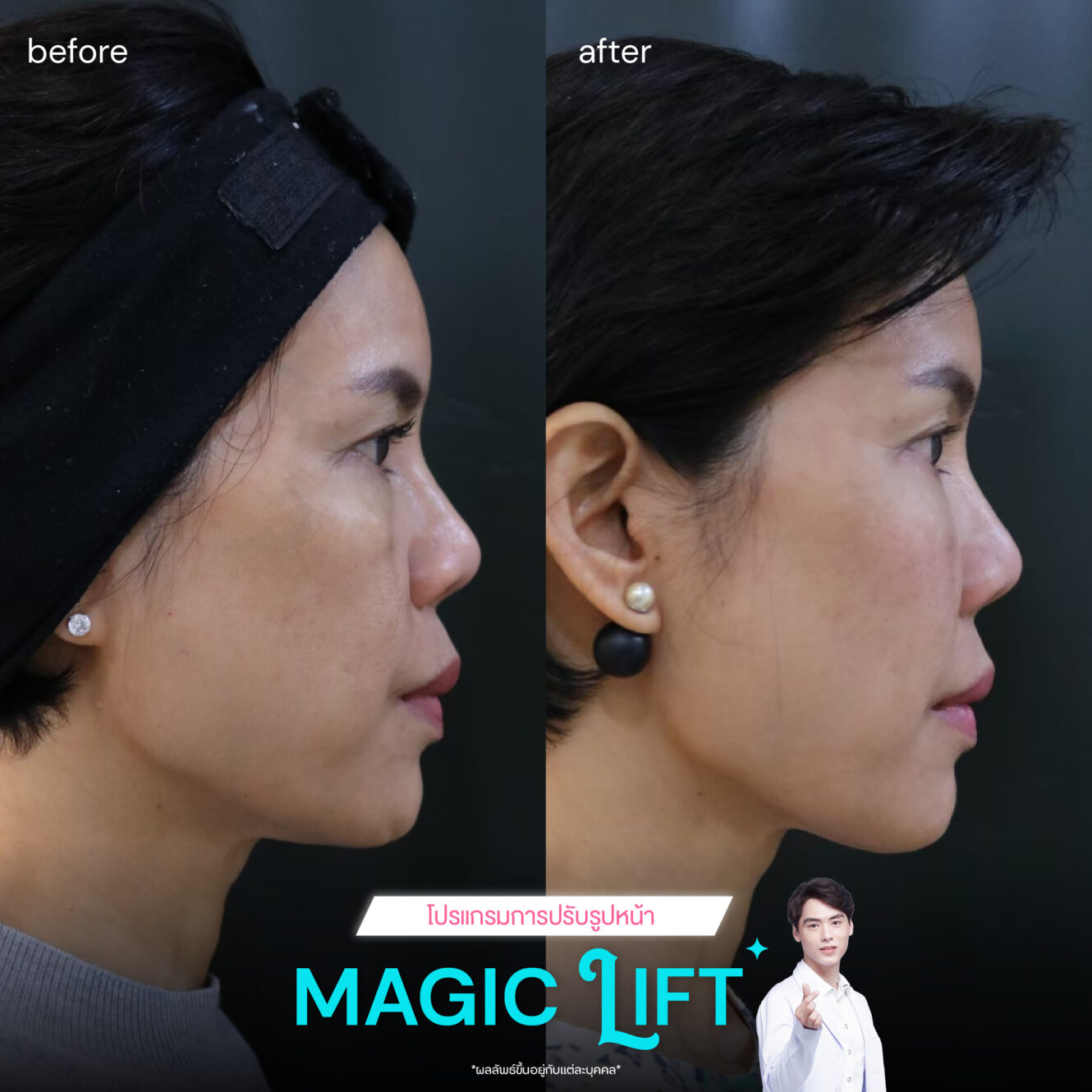 Magic-lift-review1