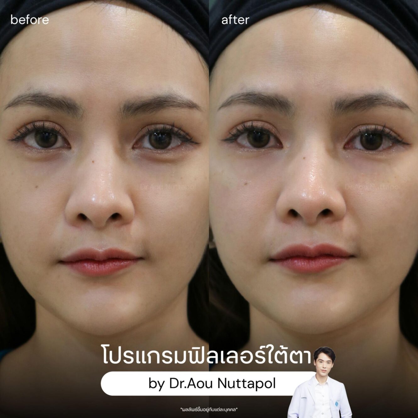 ฟิลเลอร์ใต้ตาอยู่ได้นานไหม