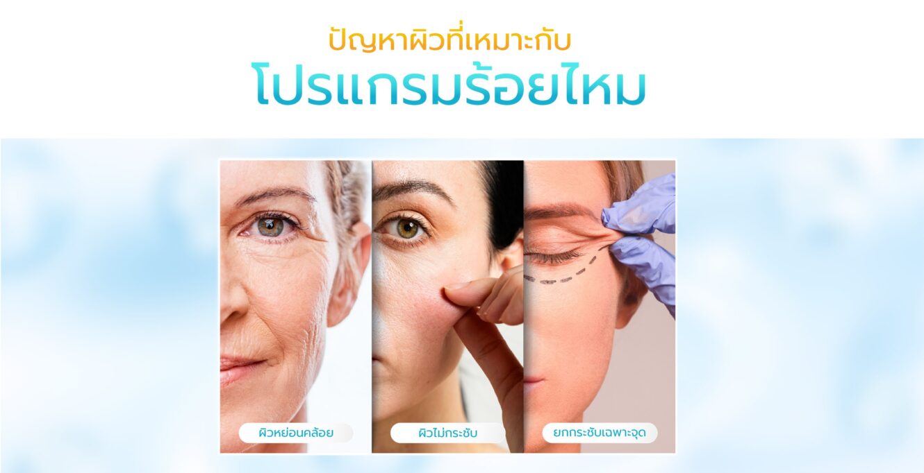 00 Guideline Thread Lift 1