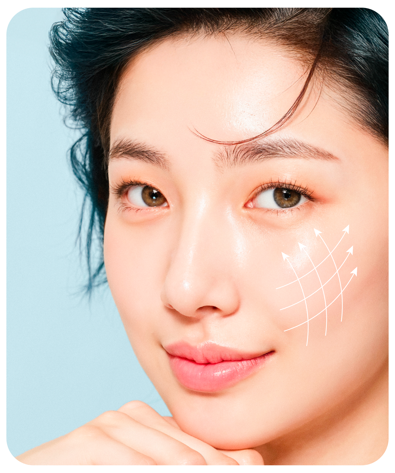 04 บริเวณ Thread Lift