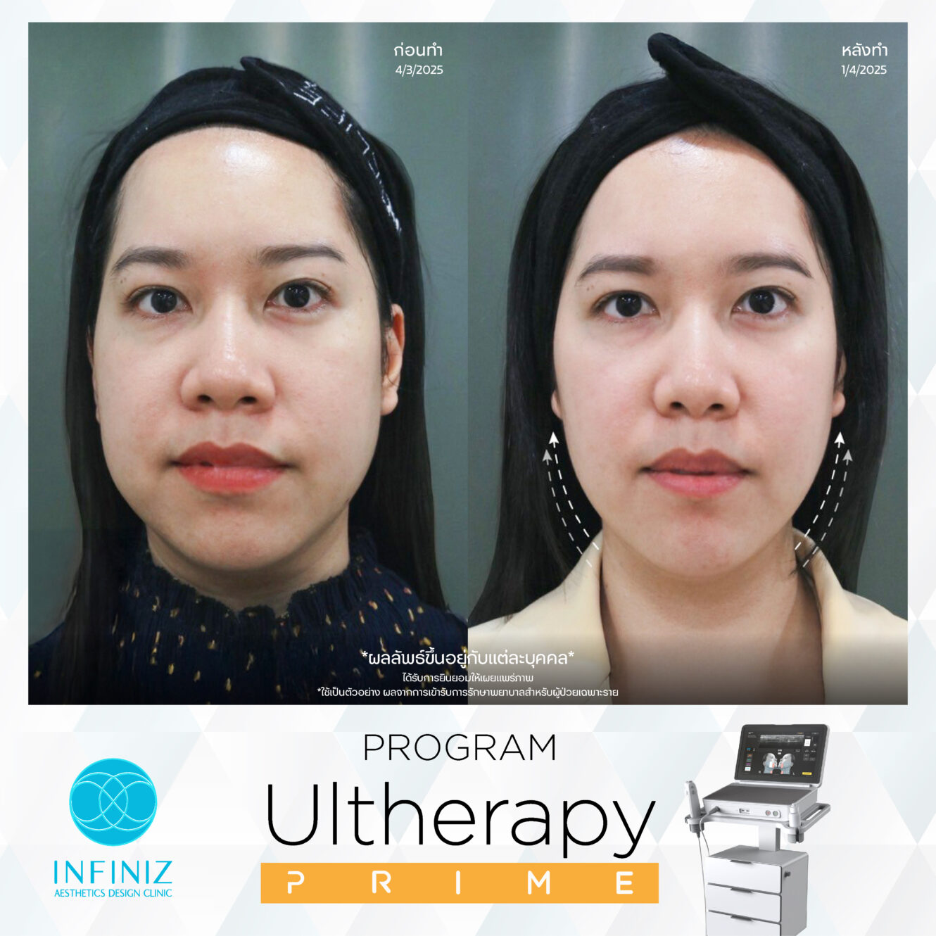 โปรแกรม Ulthera ที่ไหนดี? อยากยกกระชับหน้าทำที่ไหนดี 2025 5 Prime Mar 25 12 1