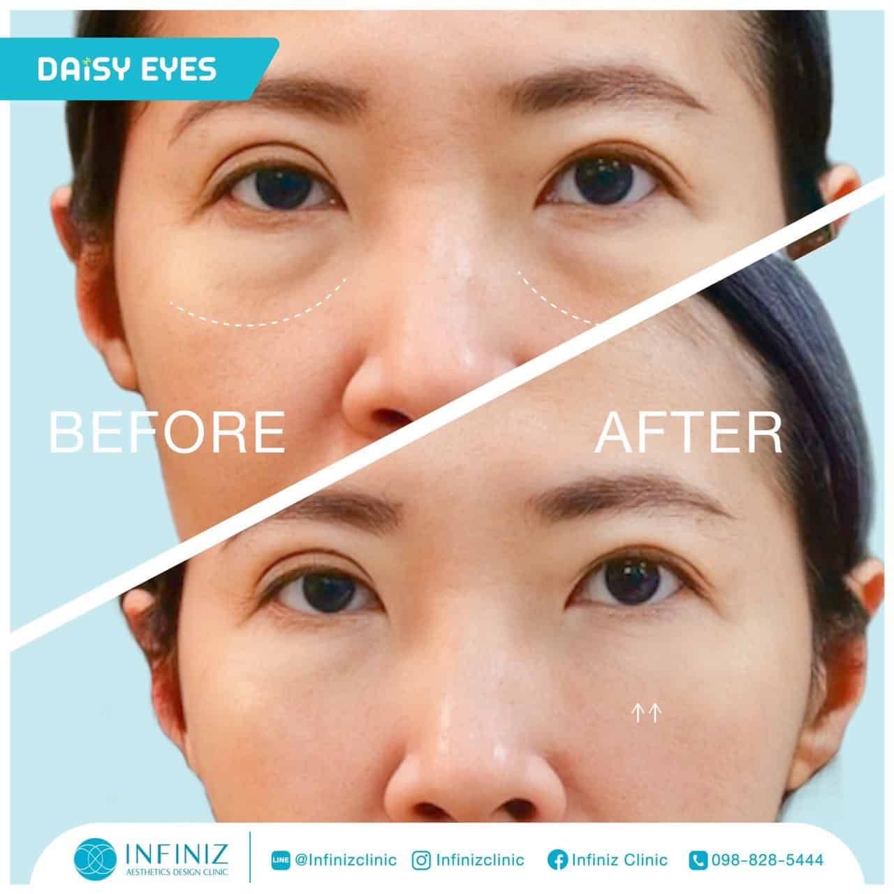 โปรแกรมฉีดฟิลเลอร์ใต้ตา แก้ปัญหาใต้ตาคล้ำ ลดถุงใต้ตา โดยไม่ต้องผ่าตัด 8 ฟิลเลอร์ใต้ตา รีวิวหลังทำ