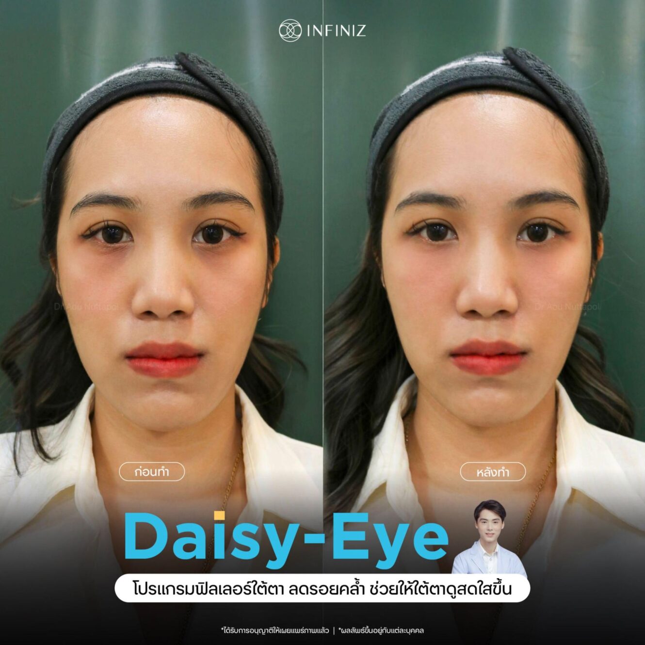 รีวิวฟิลเลอร์ใต้ตา กี่วันเห็นผล