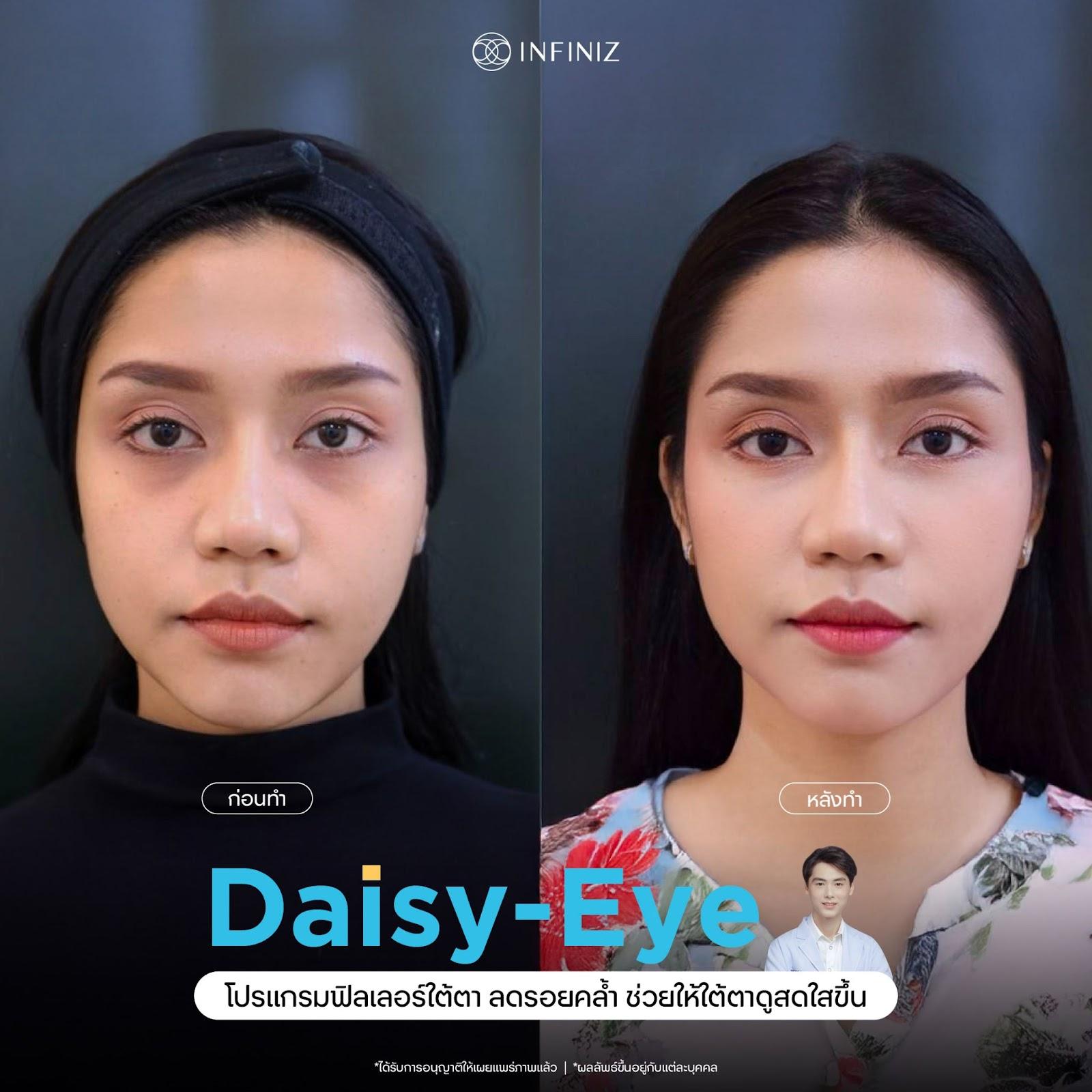 โปรแกรมฉีดฟิลเลอร์ใต้ตา แก้ปัญหาใต้ตาคล้ำ ลดถุงใต้ตา โดยไม่ต้องผ่าตัด 2 ฟิลเลอร์ใต้ตาช่วยอะไร