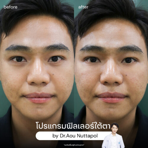 โปรแกรมฉีดฟิลเลอร์ใต้ตา แก้ปัญหาใต้ตาคล้ำ ลดถุงใต้ตา โดยไม่ต้องผ่าตัด 7 ฟิลเลอร์ใต้ตา รีวิวผลลัพธ์