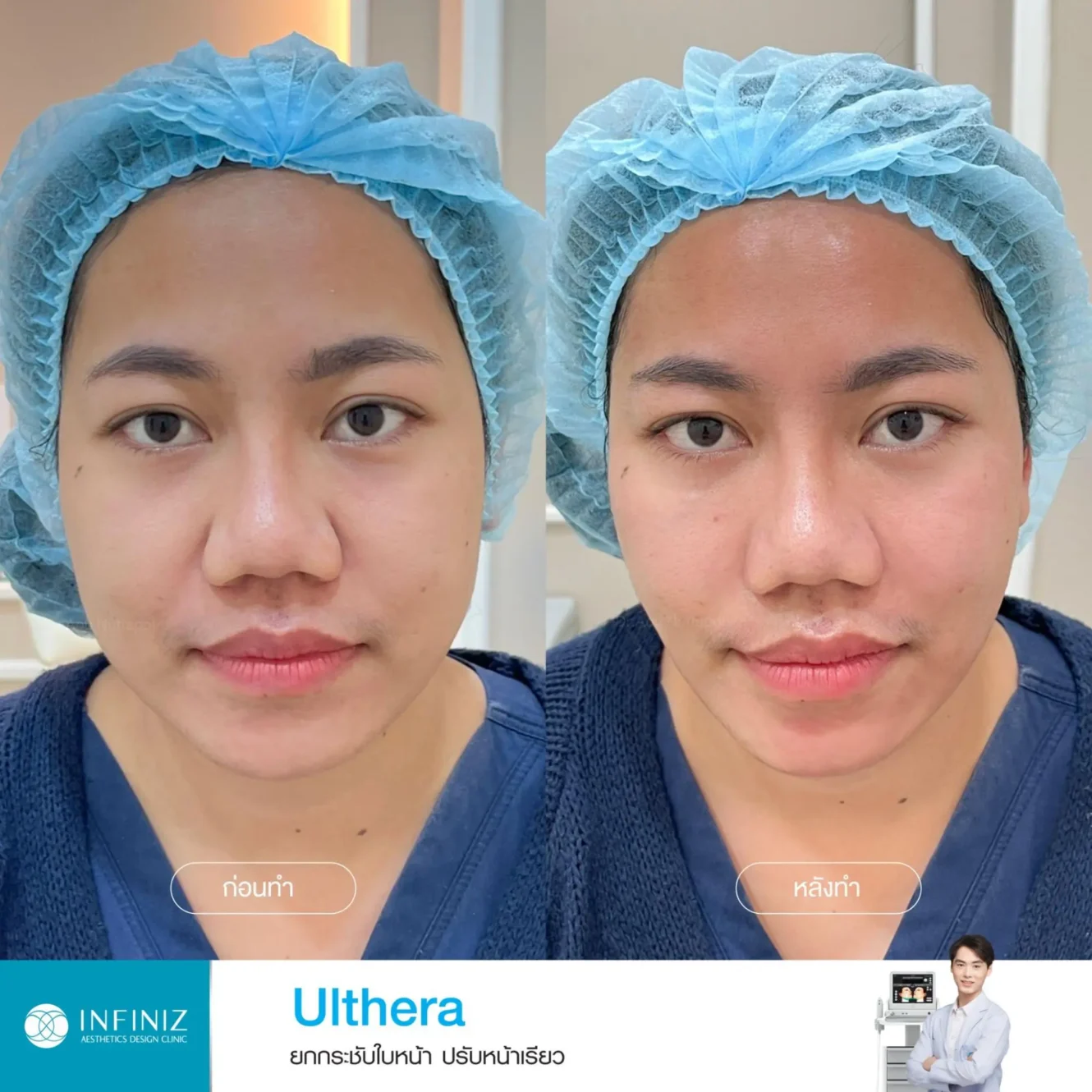 โปรแกรม Ulthera ที่ไหนดี? อยากยกกระชับหน้าทำที่ไหนดี 2025 4 รีวิวที่เห็นผลลัพธ์ ก่อน