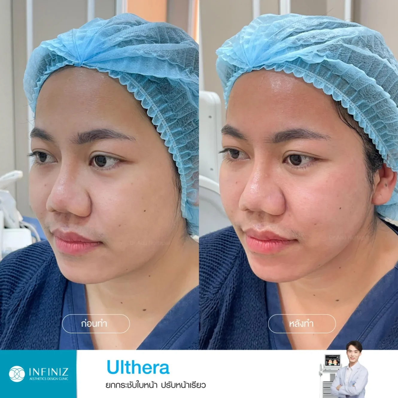 โปรแกรม Ulthera ที่ไหนดี? อยากยกกระชับหน้าทำที่ไหนดี 2025 5 หลังทำ โปรแกรม Ulthera