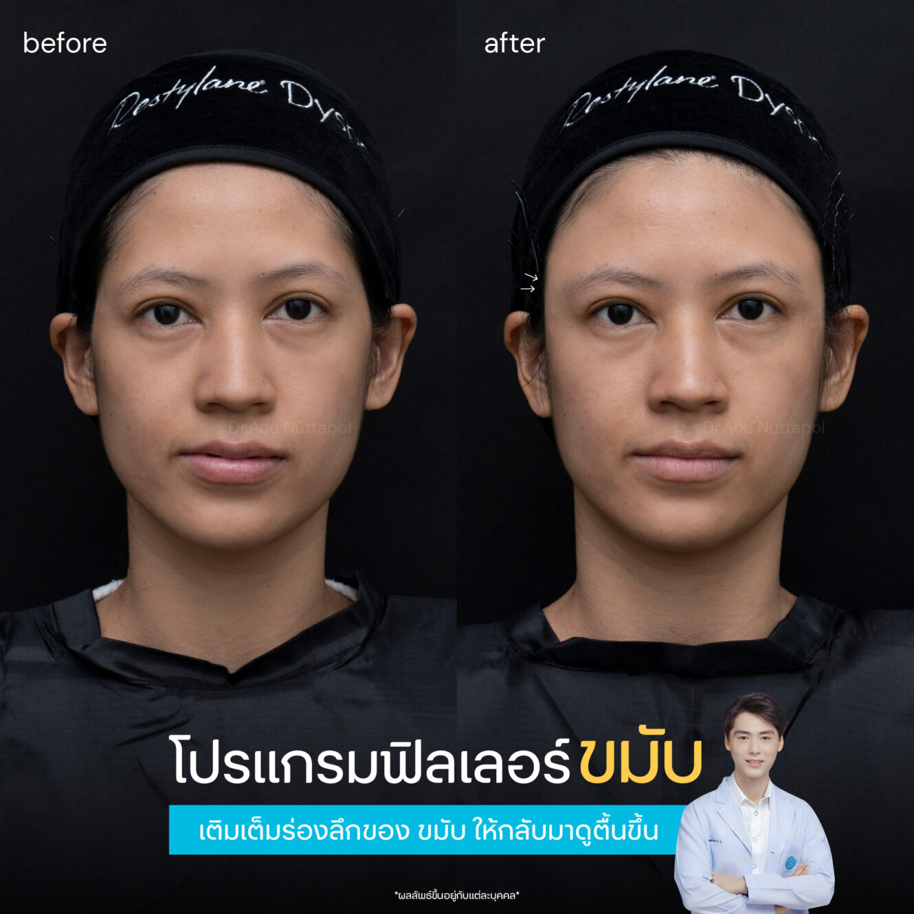 BA Filler ขมับ 02 1