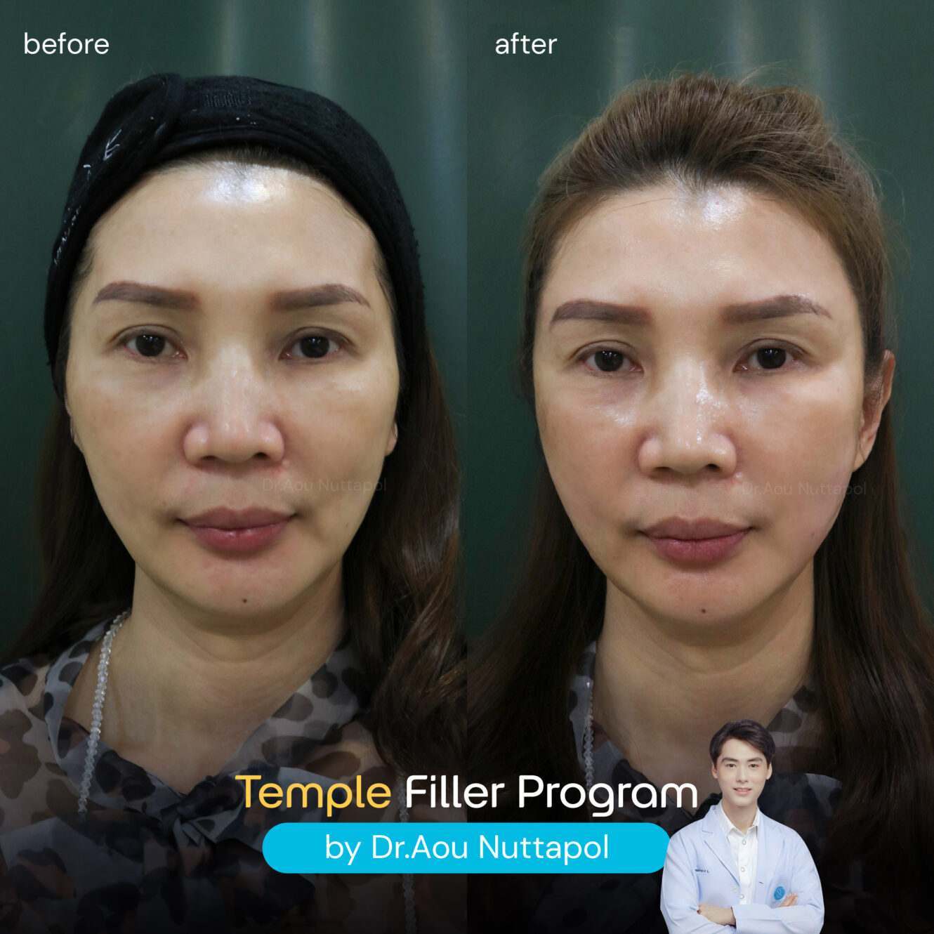 BA Filler ขมับ 03 1