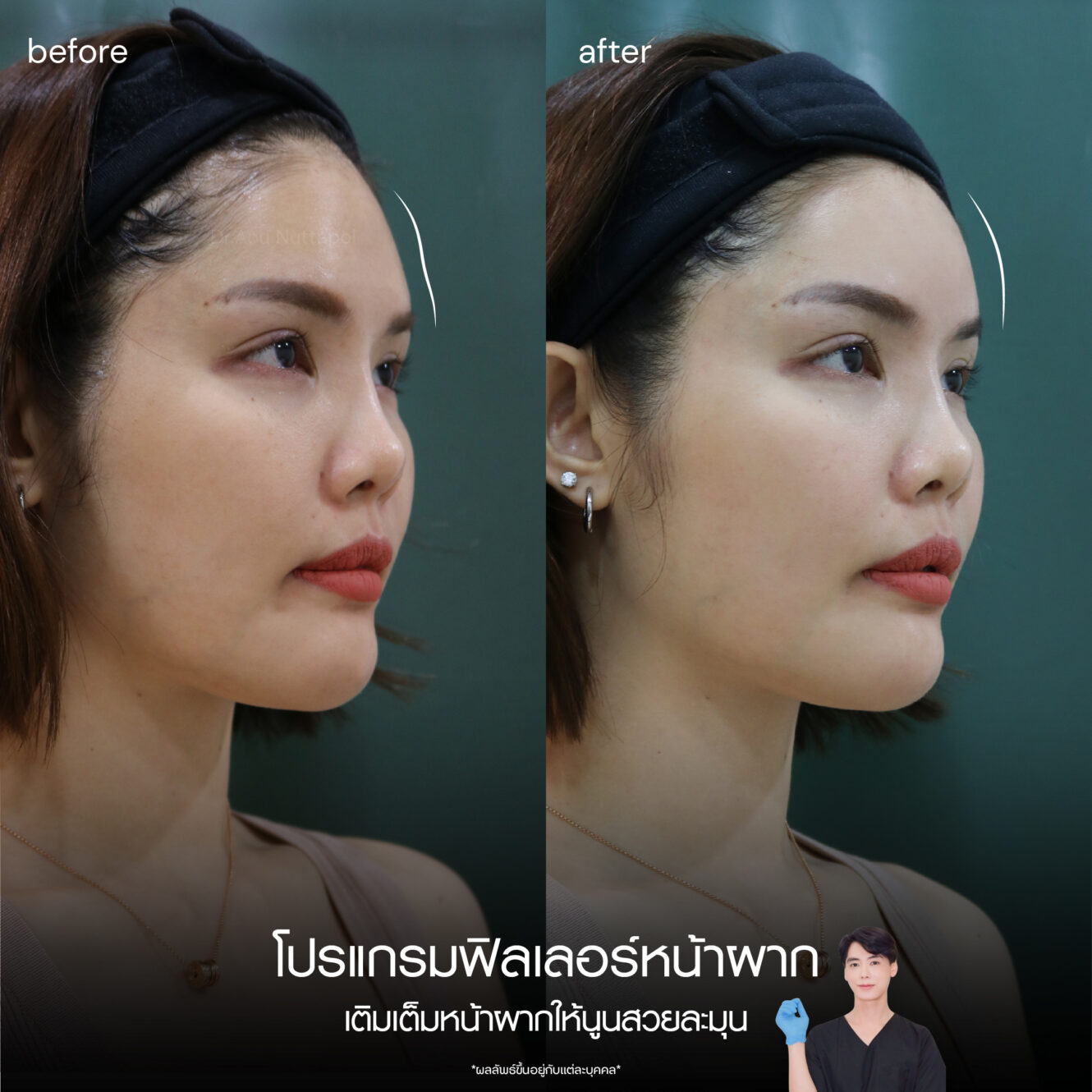BA Filler หน้าผาก 02 1