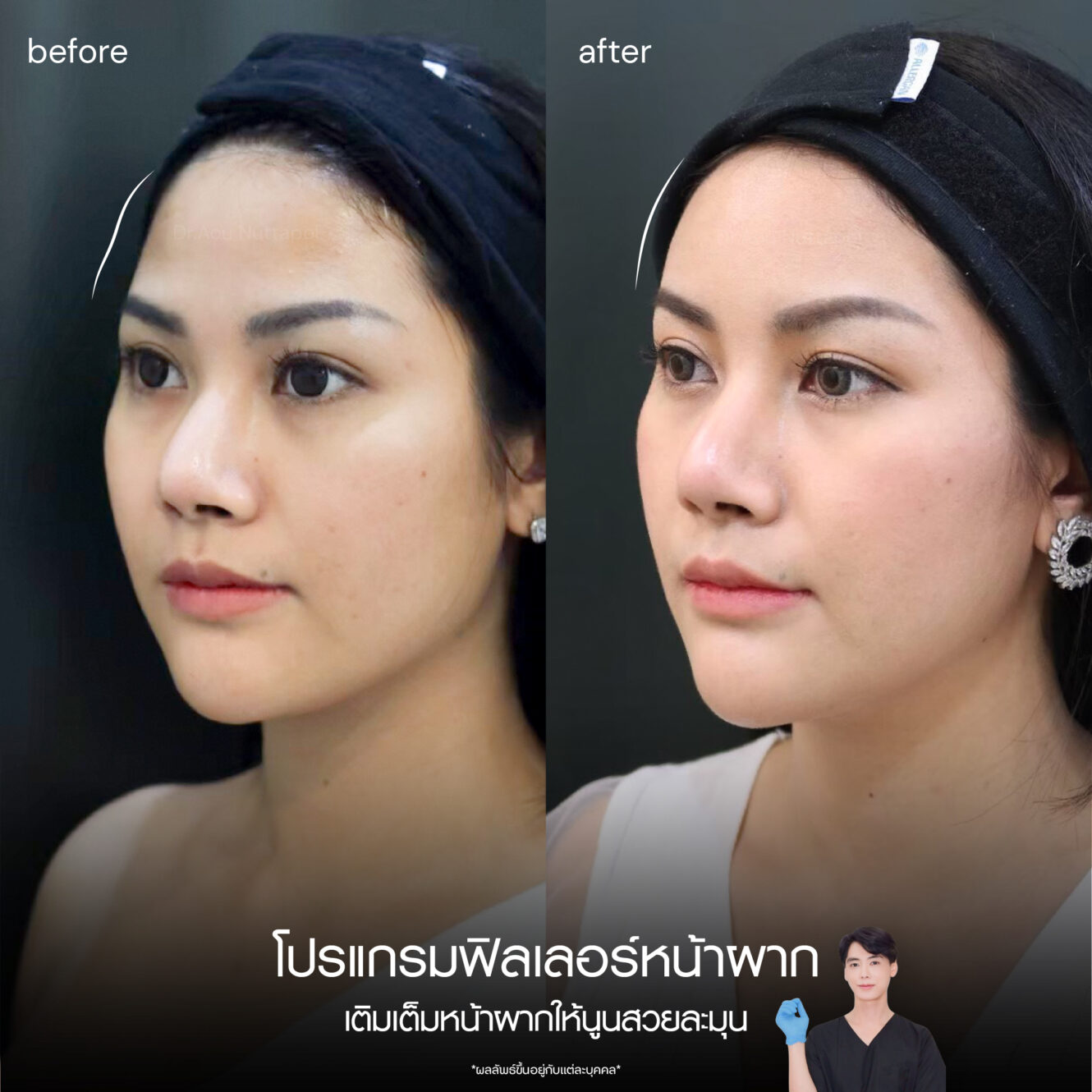 BA Filler หน้าผาก 03 1