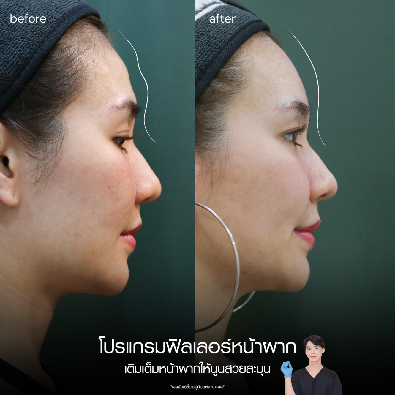 BA Filler หน้าผาก 04 1