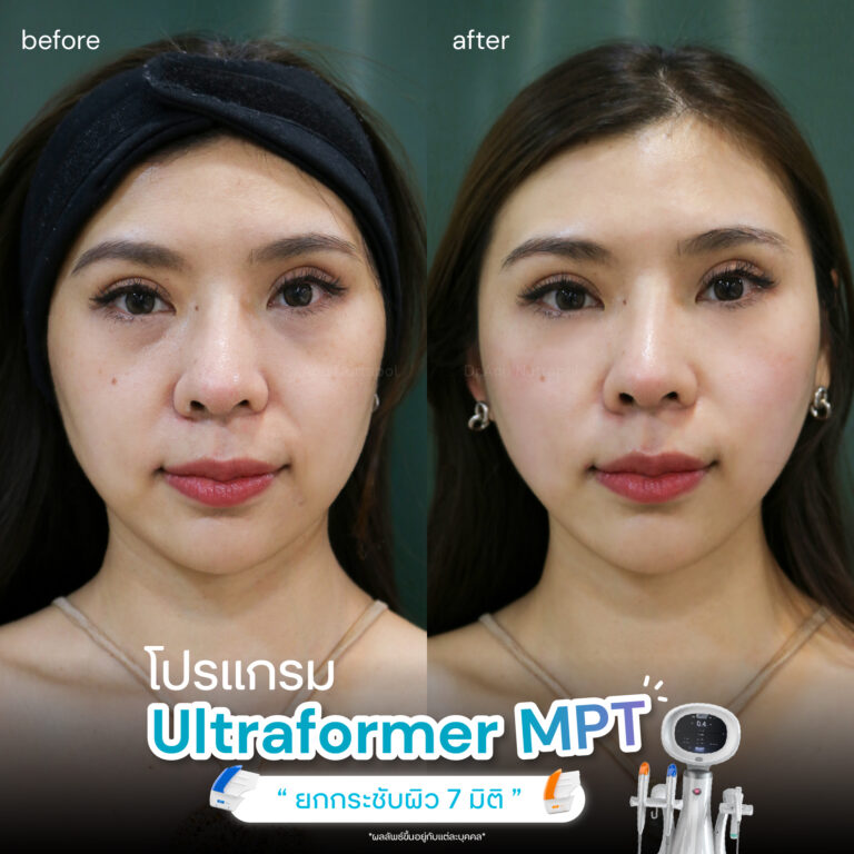 ปรับรูปหน้าให้เรียวสวย ด้วยโปรแกรมUltraformer MPT ที่ Infiniz Clinic 4 BA MPT 01 2