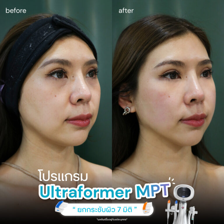 ปรับรูปหน้าให้เรียวสวย ด้วยโปรแกรมUltraformer MPT ที่ Infiniz Clinic 3 BA MPT 02 2