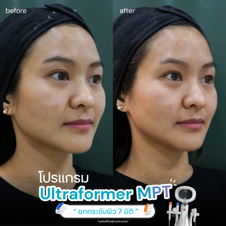 ปรับรูปหน้าให้เรียวสวย ด้วยโปรแกรมUltraformer MPT ที่ Infiniz Clinic 6 BA MPT 05 2