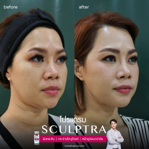 BA Sculptra 05 1