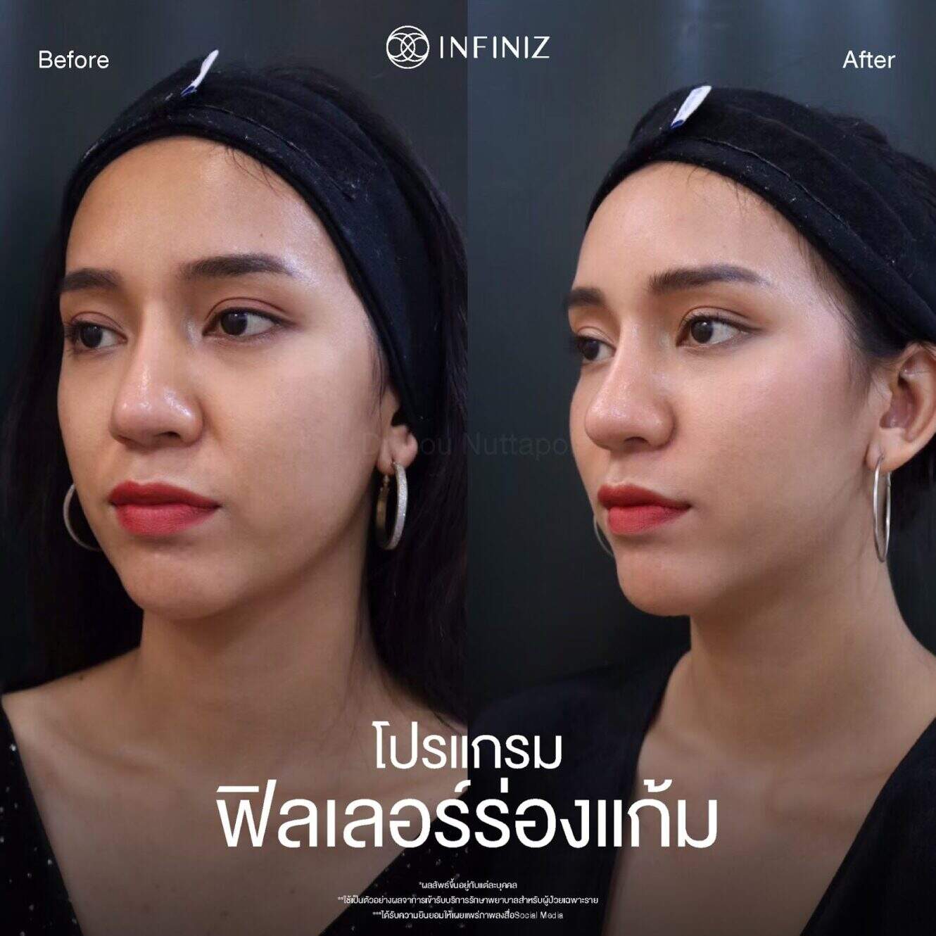ข้อควรรู้ก่อนฉีดโปรแกรมฟิลเลอร์ร่องแก้ม เตรียมตัวอย่างไรก่อนฉีด 2 ฟิลเลอร์ร่องแก้ม คือ