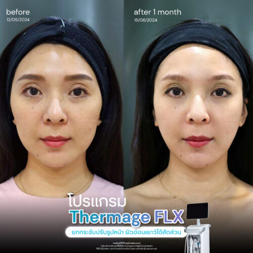 BA Thermage 05 1 1