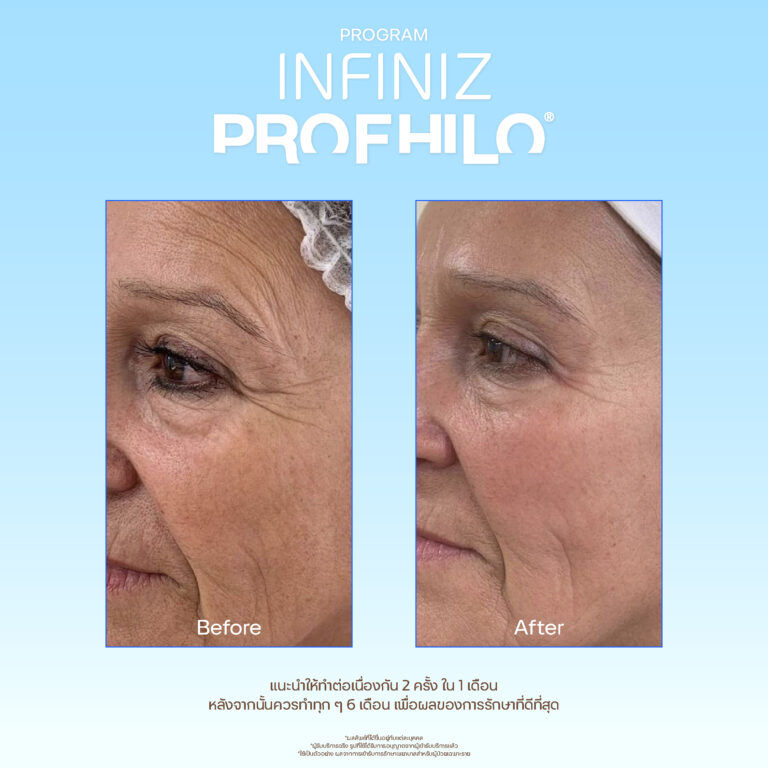 Profhilo sale kit 06
