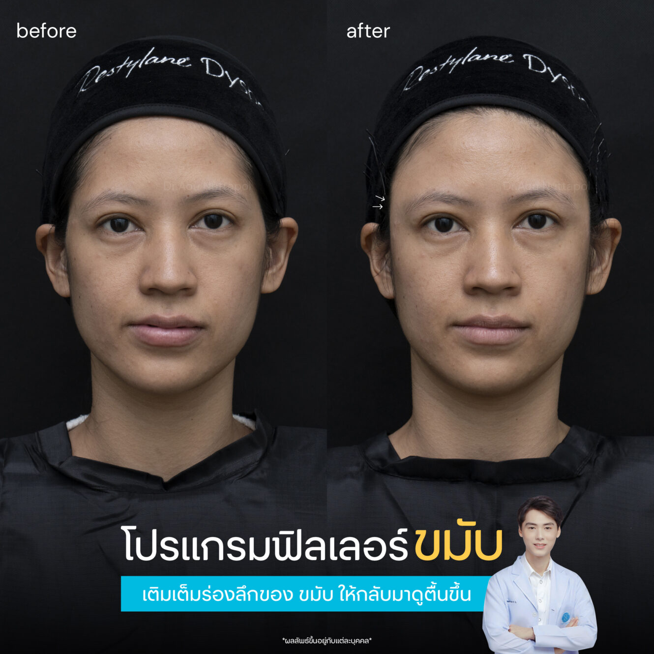 รีวิวฟิลเลอร์ขมับ