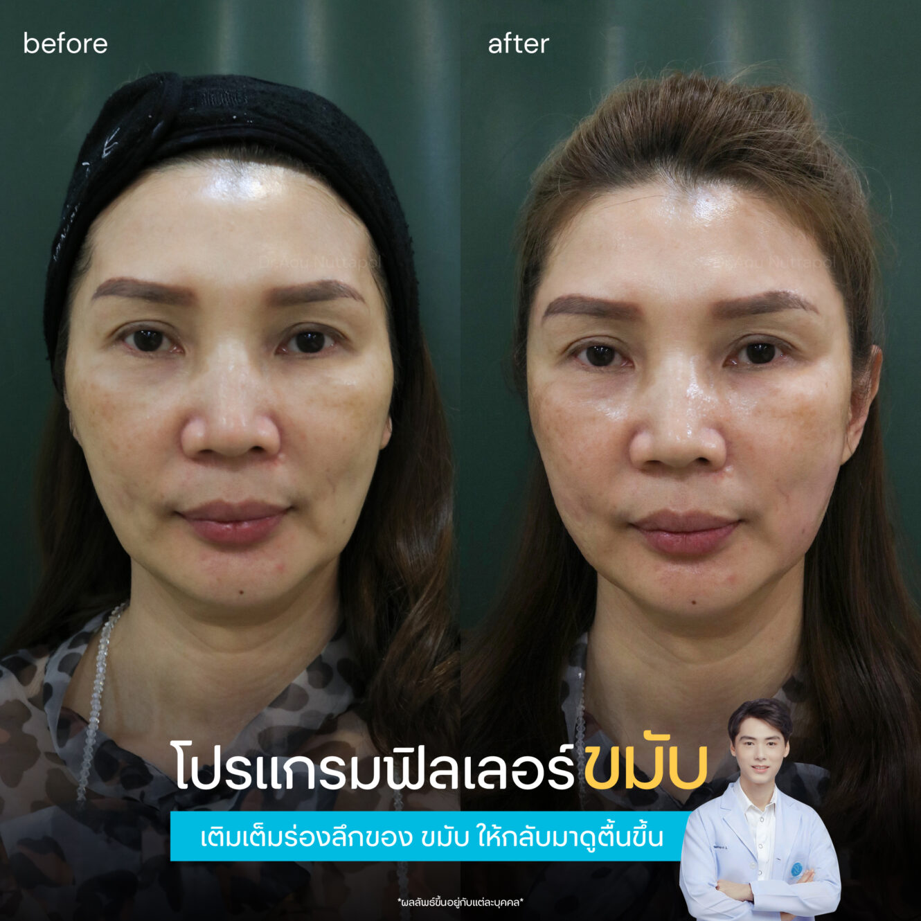 ฟิลเลอร์ขมับ รีวิว