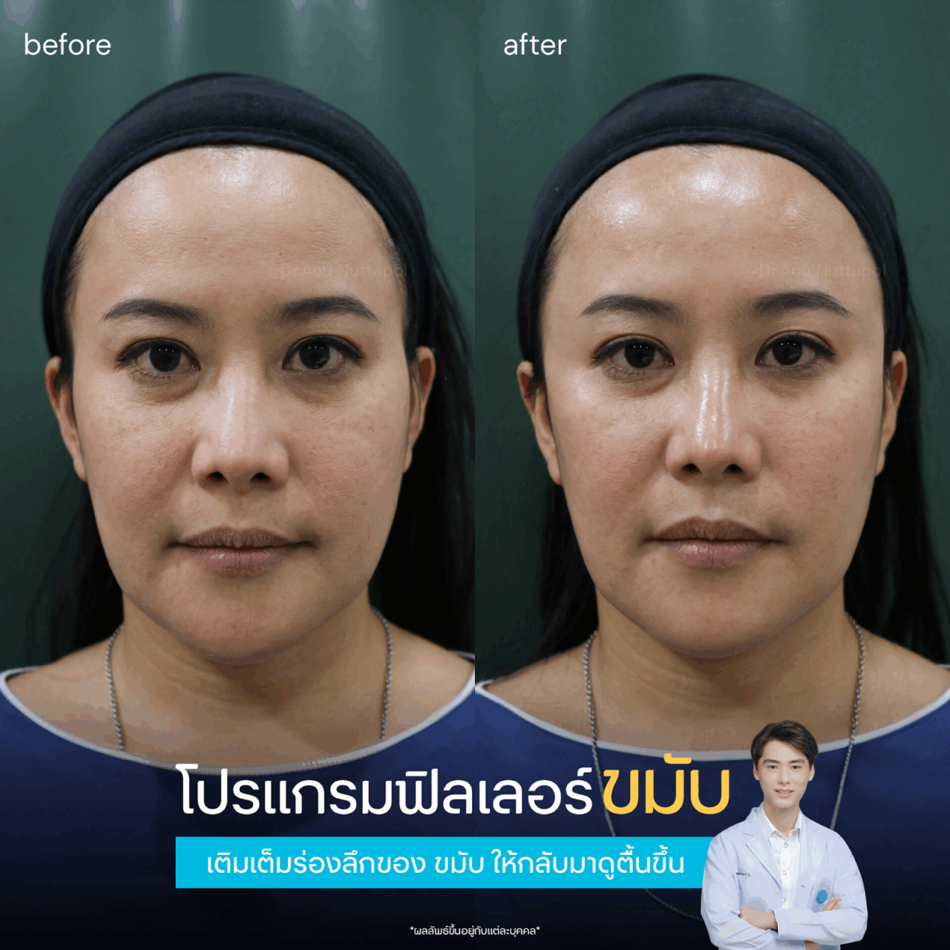 รีวิวฉีดฟิลเลอร์ขมับ