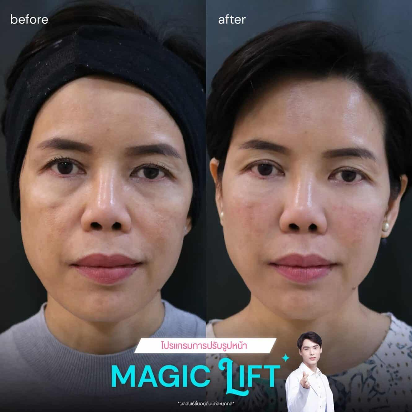 รีวิวฟิลเลอร์ร่องแก้ม