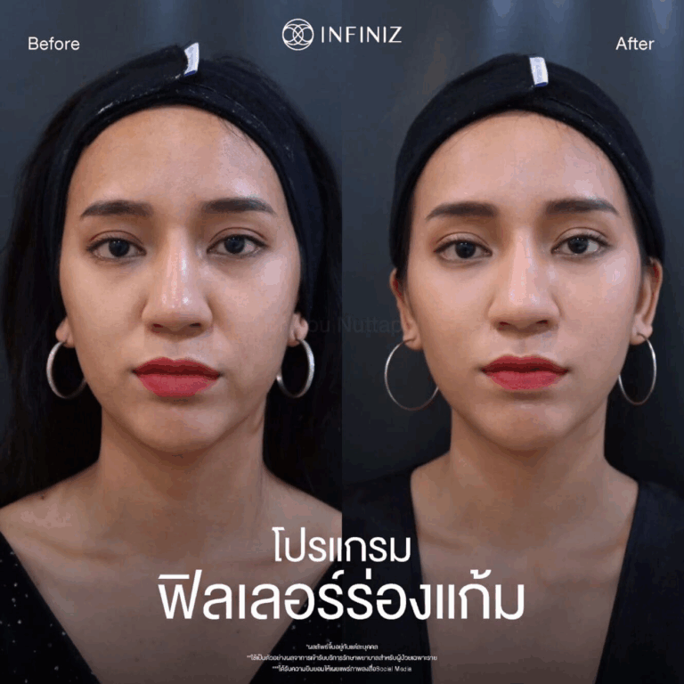 ก่อนฉีดฟิลเลอร์ร่องแก้ม