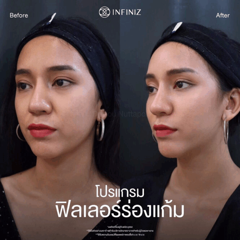 ฟิลเลอร์ร่องแก้ม คือ