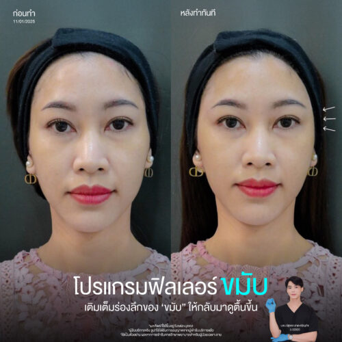 ฟิลเลอร์ขมับ คือ