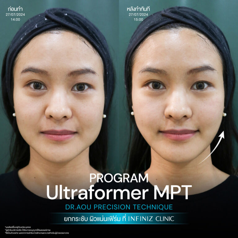 ปรับรูปหน้าให้เรียวสวย ด้วยโปรแกรมUltraformer MPT ที่ Infiniz Clinic 5 BA Oct 25 03