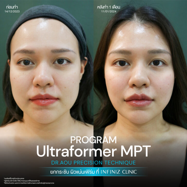 ปรับรูปหน้าให้เรียวสวย ด้วยโปรแกรมUltraformer MPT ที่ Infiniz Clinic 6 BA Oct 25 15