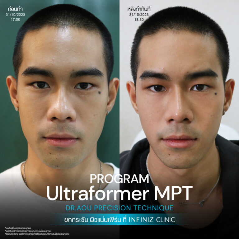 ปรับรูปหน้าให้เรียวสวย ด้วยโปรแกรมUltraformer MPT ที่ Infiniz Clinic 9 BA Oct 25 17