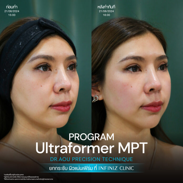 ปรับรูปหน้าให้เรียวสวย ด้วยโปรแกรมUltraformer MPT ที่ Infiniz Clinic 3 BA Oct 25 30