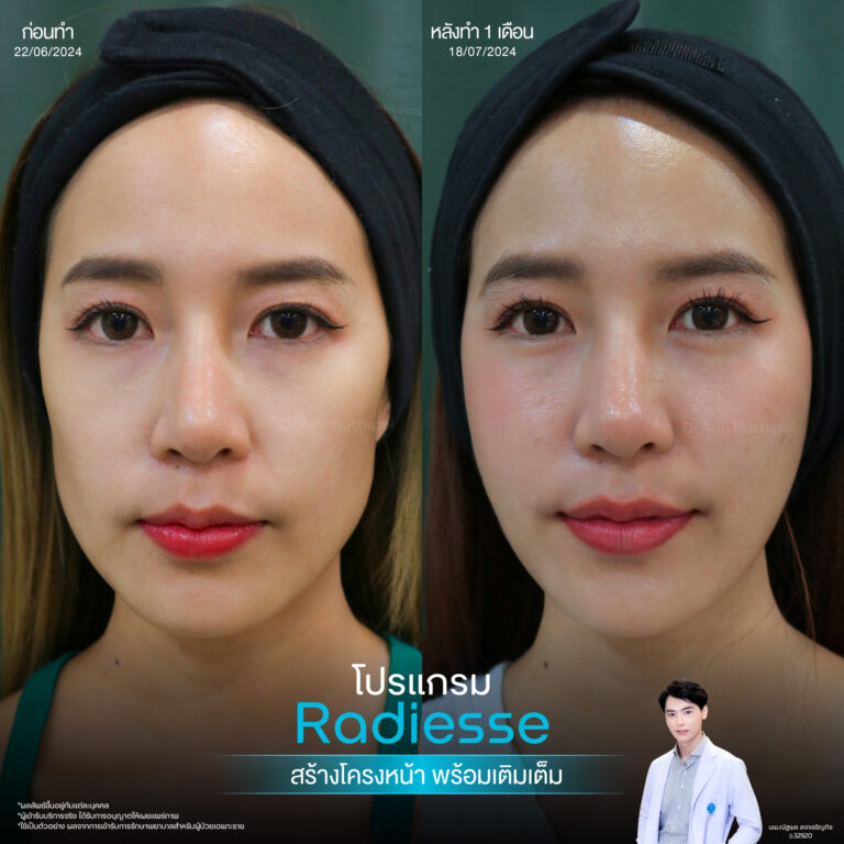 เติมเต็มผิวอิ่มฟูด้วยโปรแกรม Regenerative Radiesse Filler 3 BA Radiesse 06