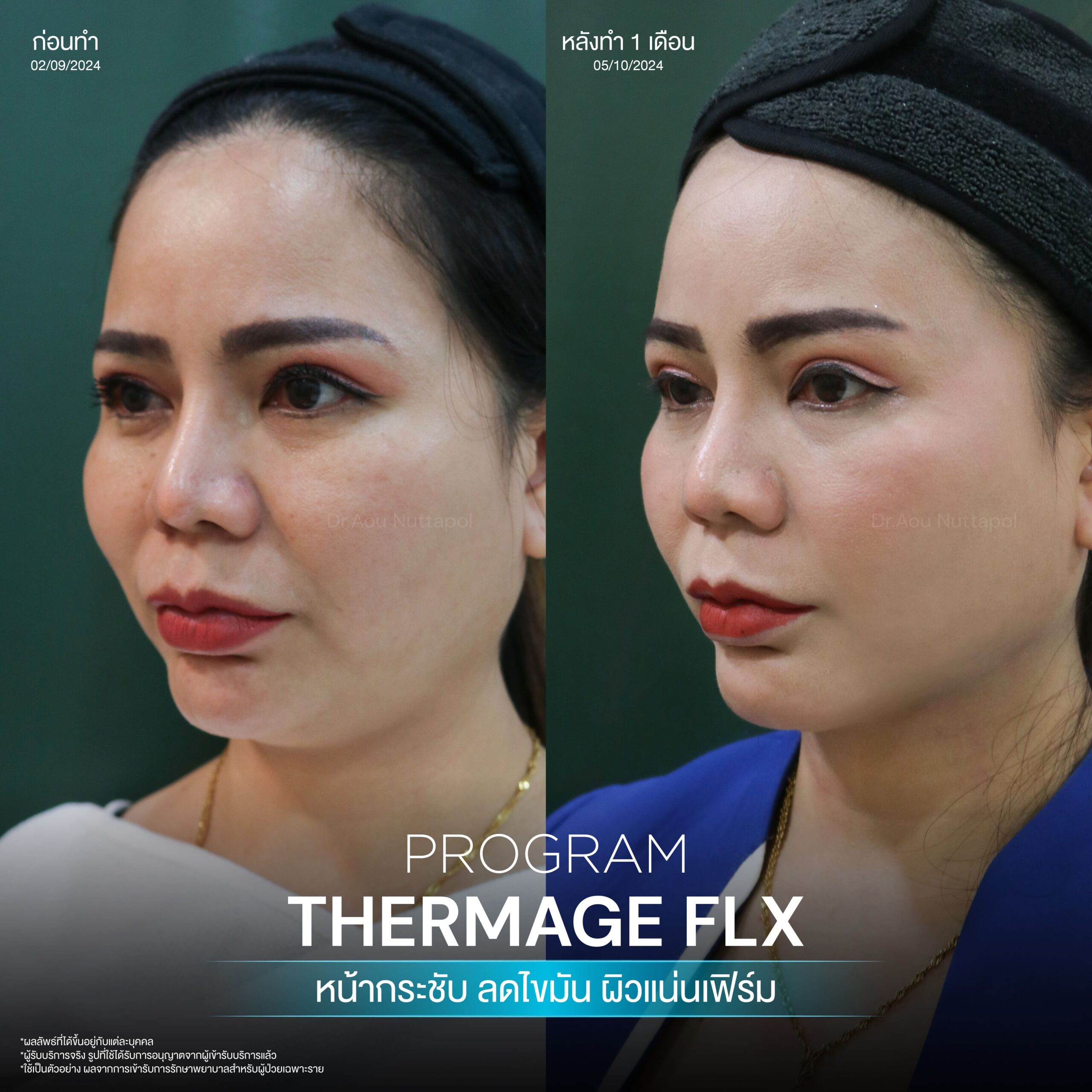 โปรแกรม Thermage FLX คืออะไรและมีหลักการทำงานอย่างไร เพื่อยกกระชับผิวหน้า 9 BA Thermage 02