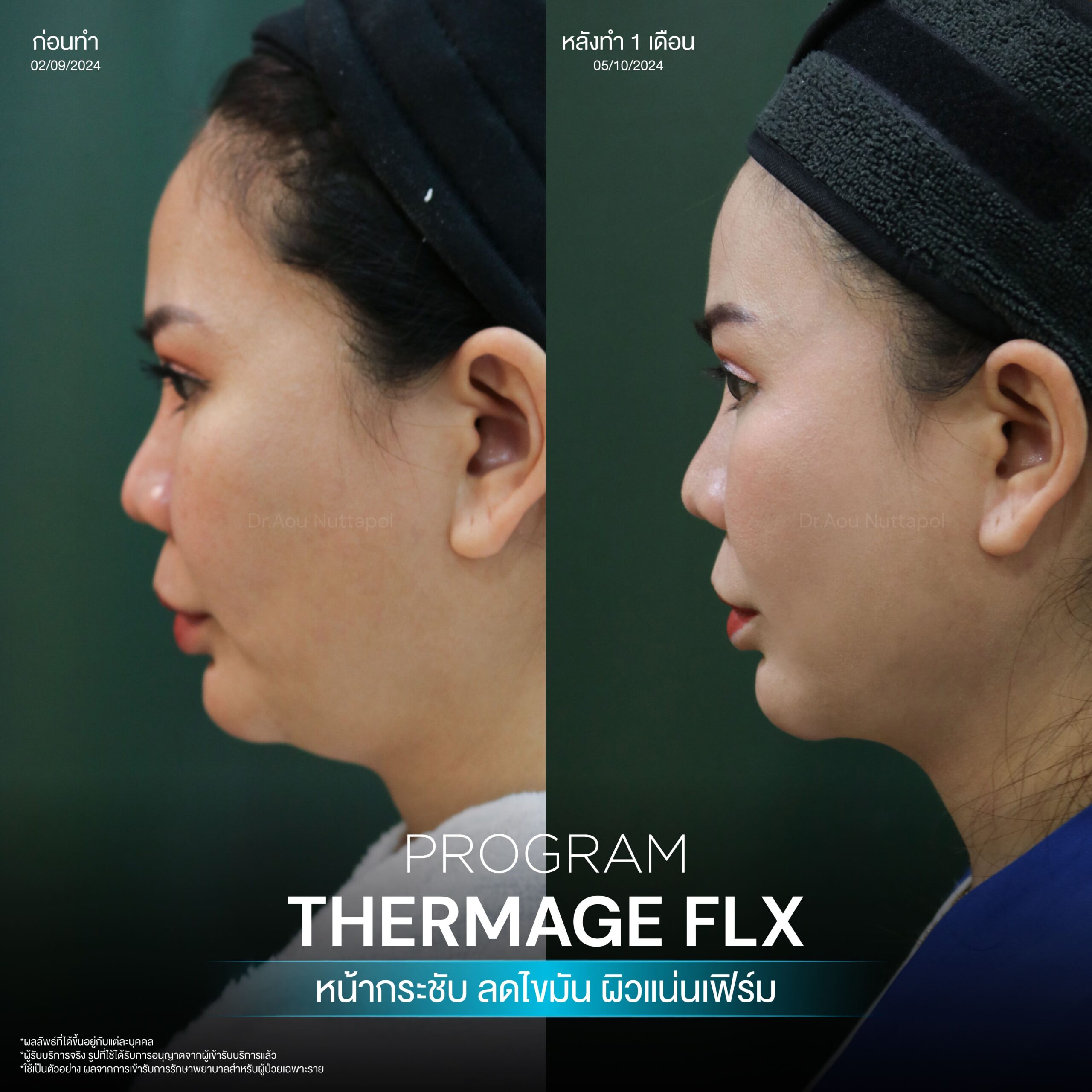 โปรแกรม Thermage FLX คืออะไรและมีหลักการทำงานอย่างไร เพื่อยกกระชับผิวหน้า 11 BA Thermage 03