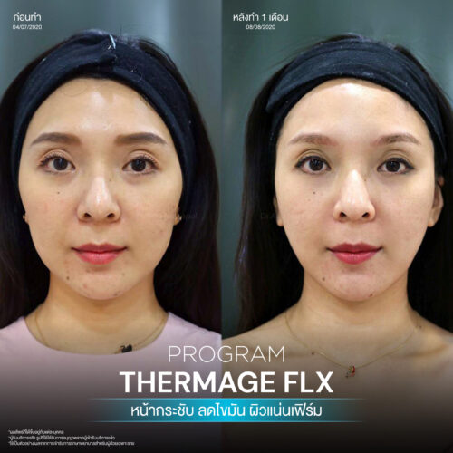 โปรแกรม Thermage FLX คืออะไรและมีหลักการทำงานอย่างไร เพื่อยกกระชับผิวหน้า 8 BA Thermage 05
