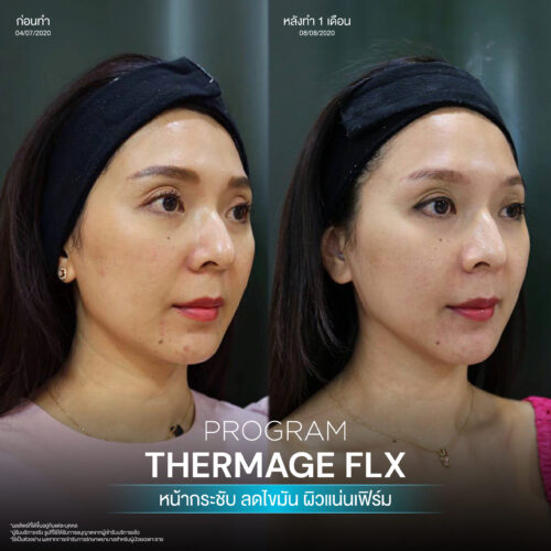 โปรแกรม Thermage FLX คืออะไรและมีหลักการทำงานอย่างไร เพื่อยกกระชับผิวหน้า 10 BA Thermage 06