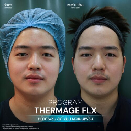 โปรแกรม Thermage FLX คืออะไรและมีหลักการทำงานอย่างไร เพื่อยกกระชับผิวหน้า 6 BA Thermage 07
