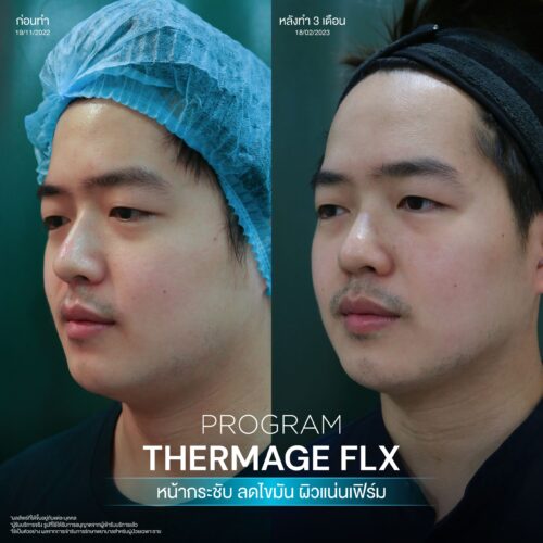 โปรแกรม Thermage FLX คืออะไรและมีหลักการทำงานอย่างไร เพื่อยกกระชับผิวหน้า 7 BA Thermage 08