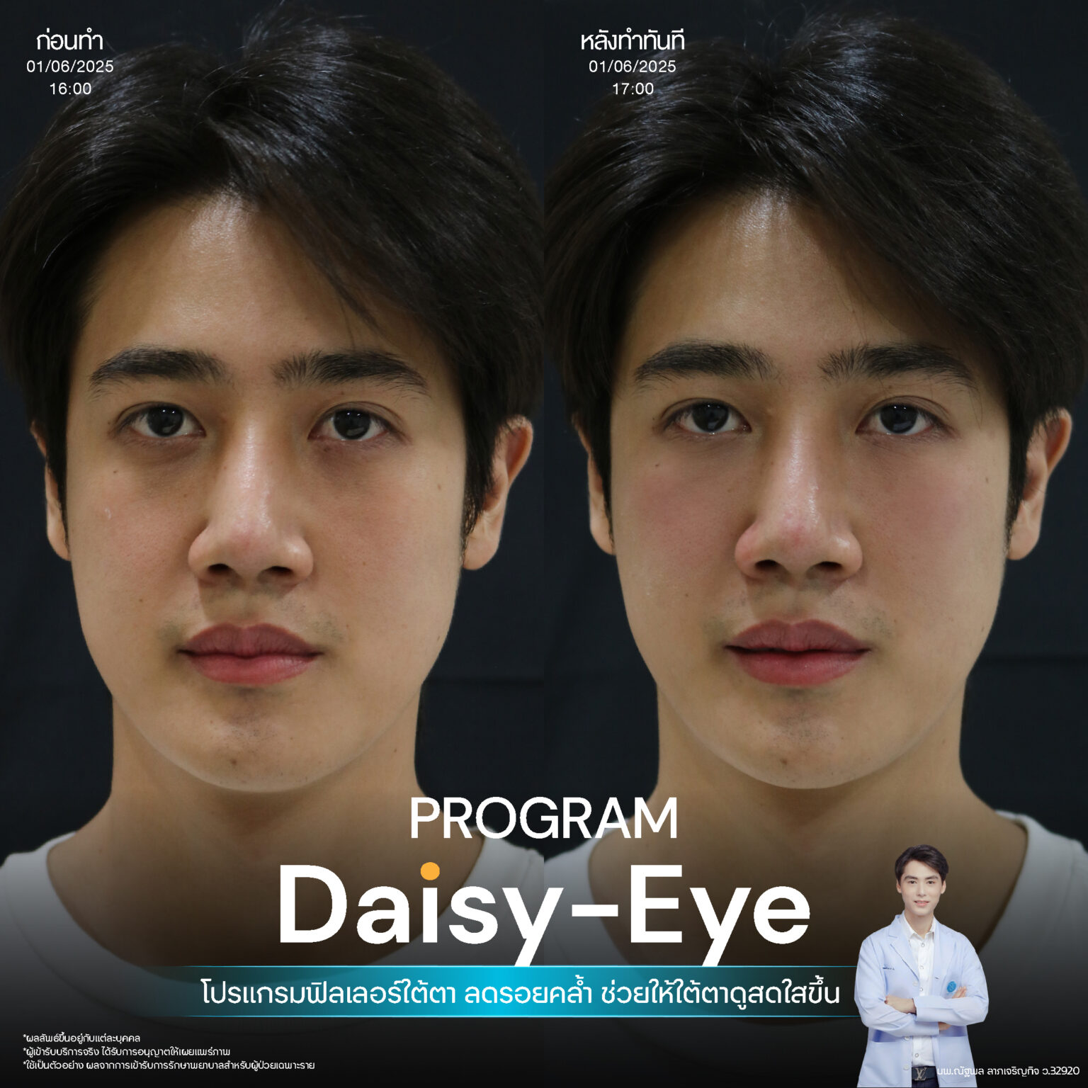 Filler ใต้ตา-07