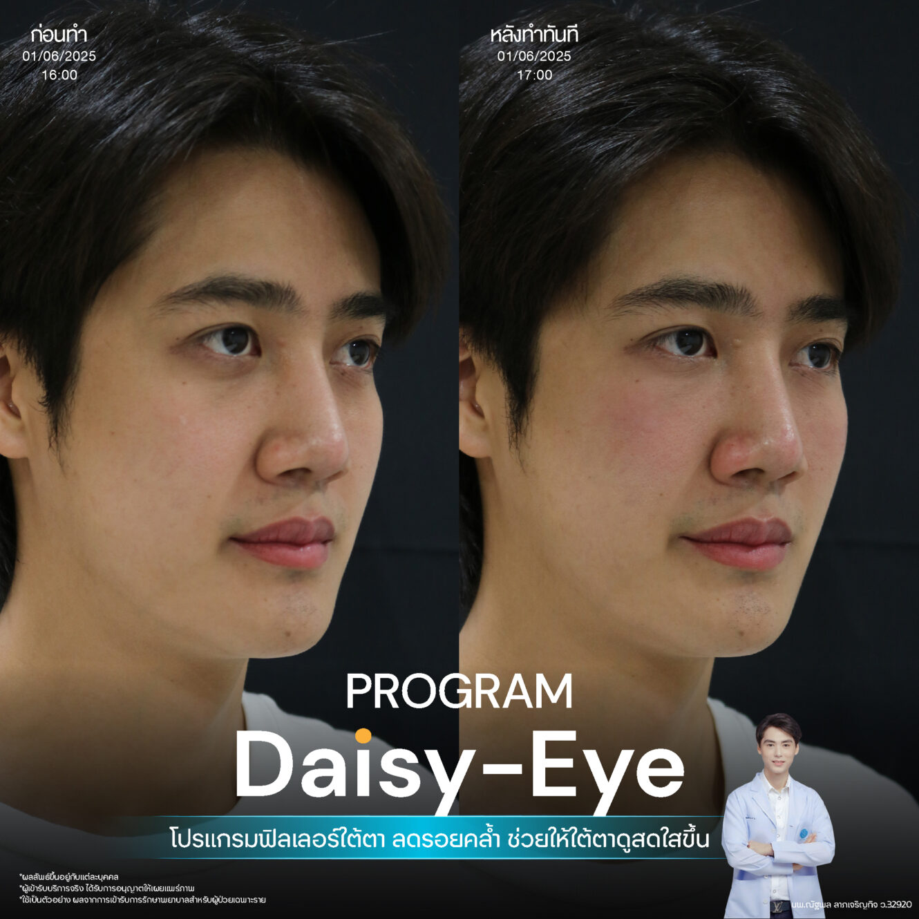 โปรแกรม Restylane Vital Light ลดริ้วรอยและร่องลึกใต้ตา 14 Filler ใต้ตา 08