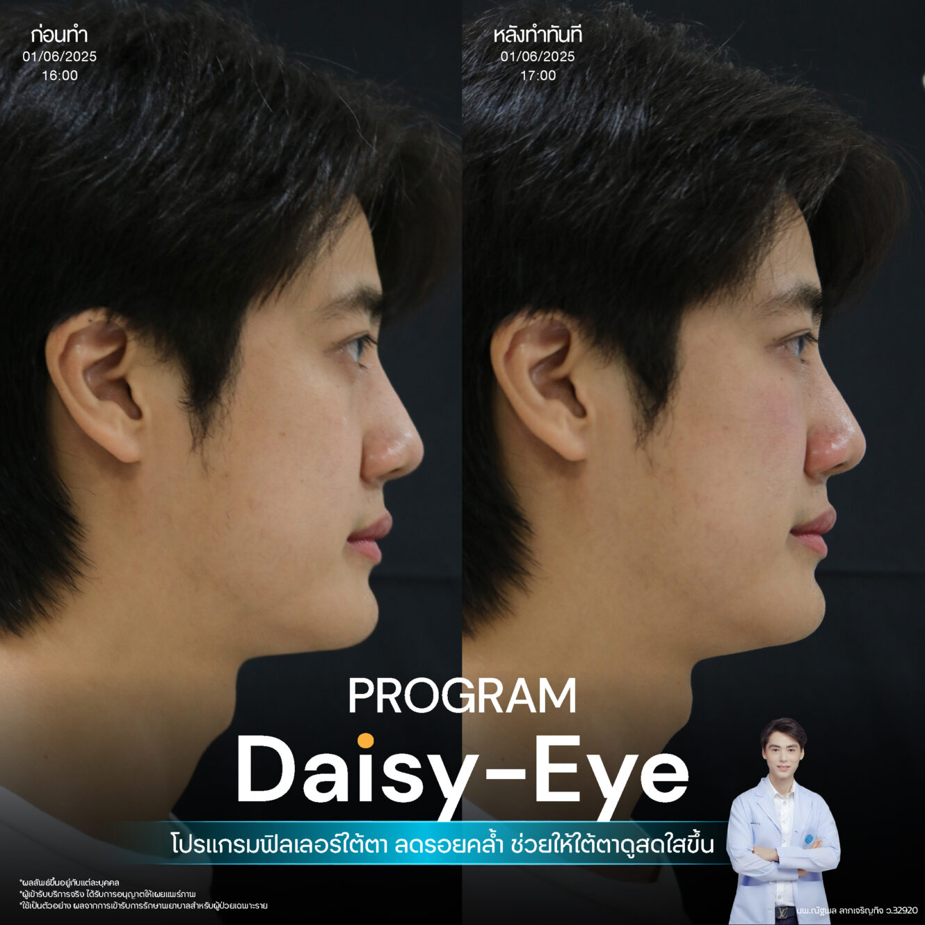 โปรแกรม Restylane Vital Light ลดริ้วรอยและร่องลึกใต้ตา 15 Filler ใต้ตา 09