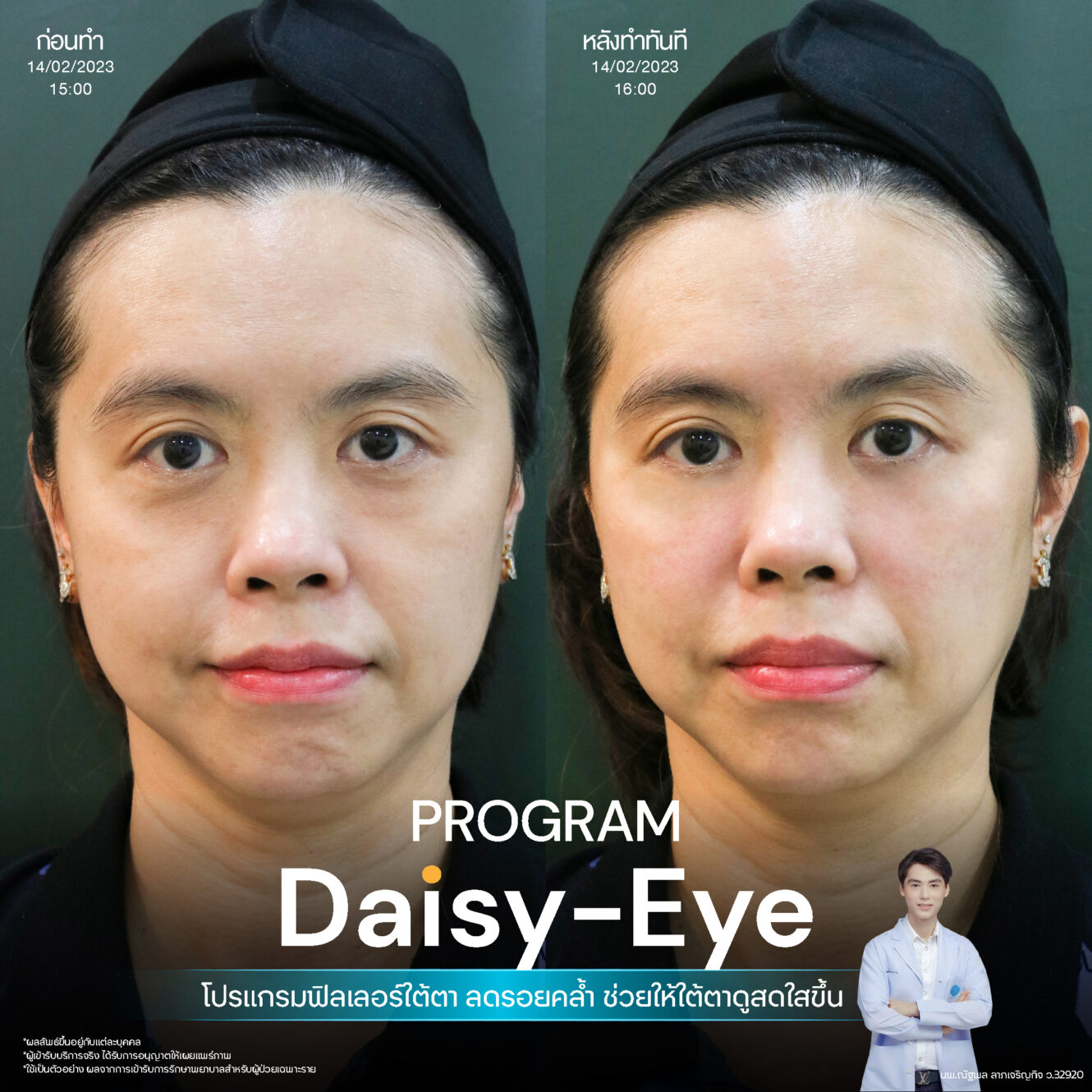 Filler ใต้ตา 12