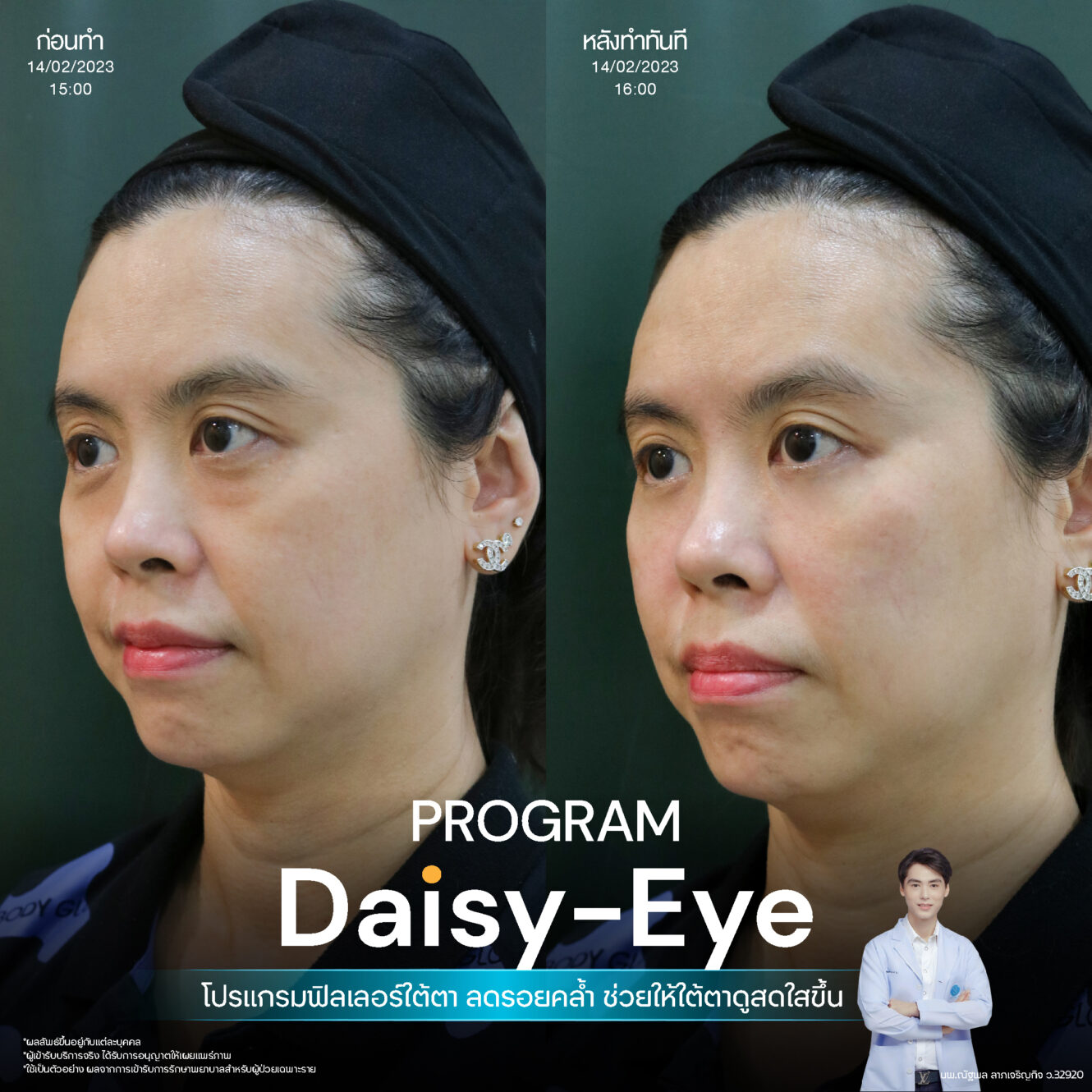 Filler ใต้ตา 13